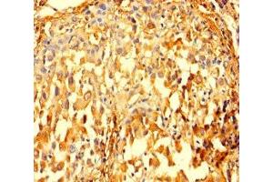 Immunohistochemistry of paraffin-embedded human lung cancer using ABIN7156292 at dilution of 1:100 (IMPDH2 anticorps  (AA 5-514))