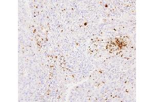IHC analysis of CEACAM5 using anti-CEACAM5 antibody (ABIN7601435). (CEACAM5 anticorps  (AA 35-650))