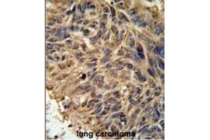 FBXL2 Antibody (C-term) (ABIN651220 and ABIN2840138) IHC analysis in formalin fixed and paraffin embedded human lung carcinoma followed by peroxidase conjugation of the secondary antibody and DAB staining. (FBXL2 anticorps  (C-Term))
