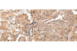 Immunohistochemistry of paraffin-embedded Human breast cancer tissue using CLDND2 Polyclonal Antibody at dilution 1:45 (CLDND2 anticorps)