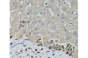 Immunohistochemistry of paraffin-embedded Human liver damage using S100A12 Polyclonal Antibody at dilution of 1:100 (40x lens). (S100A12 anticorps)