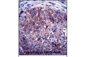 ADAL Antibody (C-term) (ABIN657544 and ABIN2846559) immunohistochemistry analysis in formalin fixed and paraffin embedded human esophagus carcinoma followed by peroxidase conjugation of the secondary antibody and DAB staining.