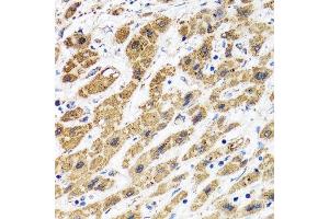 Immunohistochemistry of paraffin-embedded human liver cancer using HAPLN1 antibody.