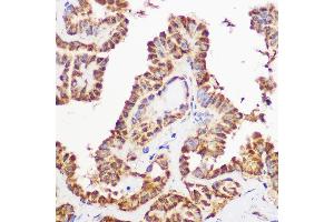 Immunohistochemistry of paraffin-embedded human thyroid using Pan-AKT antibody (ABIN7265519) at dilution of 1:100 (40x lens). (AKT 1/2/3 anticorps)