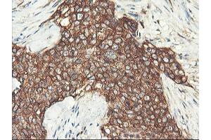 Immunohistochemical staining of paraffin-embedded Adenocarcinoma of Human breast tissue using anti-PFKP mouse monoclonal antibody. (PFKP anticorps)