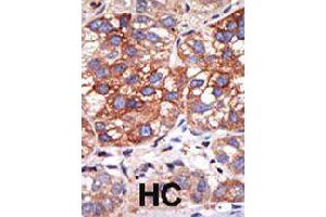 Formalin-fixed and paraffin-embedded human hepatocellular carcinoma tissue reacted with YY1 polyclonal antibody  , which was peroxidase-conjugated to the secondary antibody, followed by DAB staining . (YY1 anticorps  (N-Term))