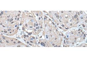 Immunohistochemistry of paraffin-embedded Human esophagus cancer tissue using HELLS Polyclonal Antibody at dilution of 1:30(x200) (HELLS anticorps)