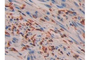 Detection of IL16 in Human Colorectal cancer Tissue using Polyclonal Antibody to Interleukin 16 (IL16)