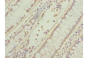 Immunohistochemistry of paraffin-embedded human colon cancer using ABIN7165317 at dilution of 1:100 (EFR3B anticorps  (AA 1-298))