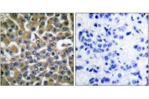 Immunohistochemistry analysis of paraffin-embedded human breast carcinoma tissue, using eEF2 (Ab-56) Antibody.