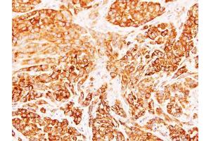 IHC-P Image Immunohistochemical analysis of paraffin-embedded A549 xenograft, using Diablo, antibody at 1:500 dilution. (DIABLO anticorps)