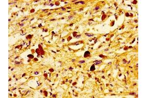 Immunohistochemistry of paraffin-embedded human melanoma using ABIN7174438 at dilution of 1:100 (UBE2D2 anticorps  (AA 1-147))