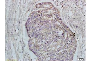 Formalin-fixed and paraffin embedded human rectal carcinoma tissue labeled with Rabbit Anti-GPR30 Polyclonal Antibody (ABIN685717) at 1:200 followed by conjugation to the secondary antibody and DAB staining.