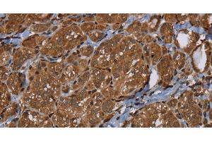 Immunohistochemistry of paraffin-embedded Human thyroid cancer using HSD17B4 Polyclonal Antibody at dilution of 1:30 (HSD17B4 anticorps)