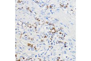 Immunohistochemistry of paraffin-embedded Human oophoroma using BOL Rabbit pAb (ABIN7265891) at dilution of 1:50 (40x lens).