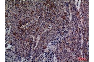 Immunohistochemistry (IHC) analysis of paraffin-embedded Human Lung Cancer, antibody was diluted at 1:100. (CDC34 anticorps  (Internal Region))