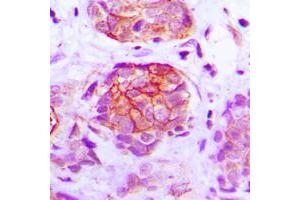 Immunohistochemical analysis of GPR160 staining in human breast cancer formalin fixed paraffin embedded tissue section.