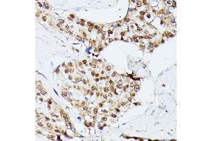 Immunohistochemistry of paraffin-embedded human breast cancer using KIF22 antibody  at dilution of 1:100 (40x lens).