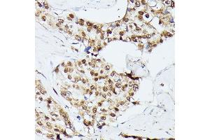 Immunohistochemistry of paraffin-embedded human breast cancer using KIF22 antibody  at dilution of 1:100 (40x lens). (KIF22 anticorps  (AA 456-665))
