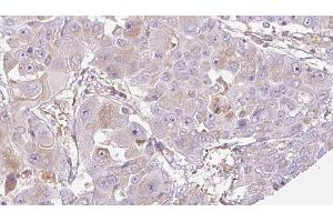 ABIN6272705 at 1/100 staining Human liver cancer tissue by IHC-P. (OR52J3 anticorps  (N-Term))