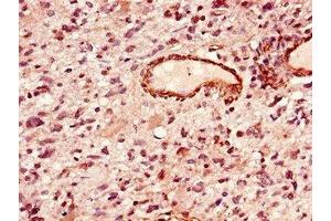 Immunohistochemistry of paraffin-embedded human glioma using ABIN7155905 at dilution of 1:100 (LIPE anticorps  (AA 1-251))
