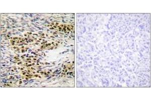 Immunohistochemistry analysis of paraffin-embedded human ovary tissue, using Akt (Ab-246) Antibody. (AKT1 anticorps  (AA 212-261))