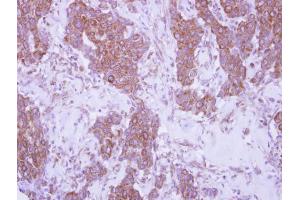 IHC-P Image Immunohistochemical analysis of paraffin-embedded human breast cancer, using CD79b, antibody at 1:250 dilution. (CD79b anticorps  (Center))