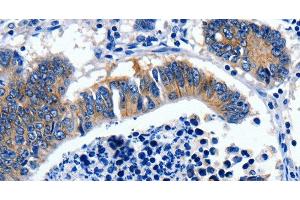 Immunohistochemistry of paraffin-embedded Human colon cancer tissue using GAD2 Polyclonal Antibody at dilution 1:30 (GAD65 anticorps)