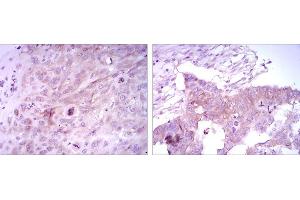Immunohistochemical analysis of paraffin-embedded lung cancer tissues (left) and ovarian cancer tissues (right) using FOXD3 mouse mAb with DAB staining.