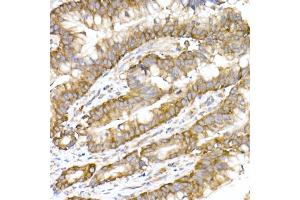 Immunohistochemistry of paraffin-embedded human colon carcinoma using RPL10A Rabbit mAb (ABIN7269992) at dilution of 1:25 (40x lens). (RPL10A anticorps)