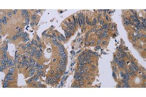Immunohistochemistry of paraffin-embedded Human colon cancer using PRKD3 Polyclonal Antibody at dilution of 1:50 (PRKD3 anticorps)