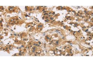 Immunohistochemistry of paraffin-embedded Human thyroid cancer using GAS7 Polyclonal Antibody at dilution of 1:50 (GAS7 anticorps)
