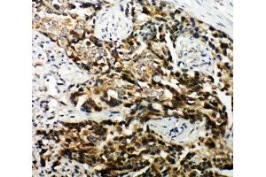 IHC-P: TSC1 antibody testing of human breast cancer tissue (TSC1 anticorps  (C-Term))