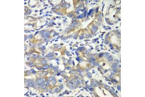 Immunohistochemistry of paraffin-embedded human gastric cancer using ABAT antibody (ABIN1876487) at dilution of 1:100 (40x lens). (ABAT anticorps)