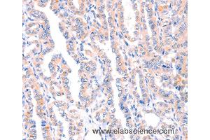 Immunohistochemistry of Human thyroid cancer using AMPD1 Polyclonal Antibody at dilution of 1:70 (AMPD1 anticorps)