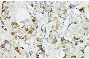 Immunohistochemistry of paraffin-embedded Human mammary cancer using Complement Factor B Polyclonal Antibody at dilution of 1:200 (40x lens). (Complement Factor B anticorps)