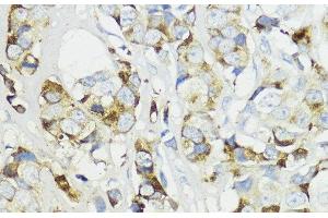 Immunohistochemistry of paraffin-embedded Human mammary cancer using Complement Factor B Polyclonal Antibody at dilution of 1:200 (40x lens).