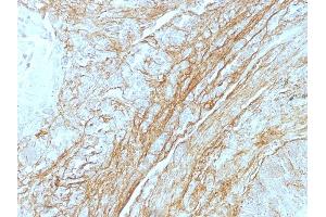 Formalin-fixed, paraffin-embedded human Lung Carcinoma stained with Tenascin C Monoclonal Antibody (T2H5).