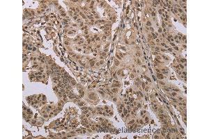Immunohistochemistry of Human gastric cancer using CAB39 Polyclonal Antibody at dilution of 1:50 (CAB39 anticorps)