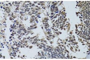 Immunohistochemistry of paraffin-embedded Human lung cancer using LKB1 Polyclonal Antibody at dilution of 1:100 (40x lens). (LKB1 anticorps)