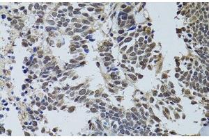 Immunohistochemistry of paraffin-embedded Human lung cancer using LKB1 Polyclonal Antibody at dilution of 1:100 (40x lens).