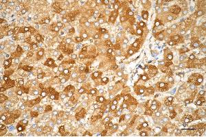 Immunohistochemistry was performed on paraffin-embedded human hepatocarcinoma using MRC1 antibody (ABIN7799330), 1:100).