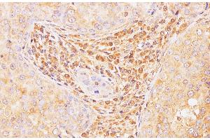 Immunohistochemistry of paraffin-embedded Human breast cancer using Il2 Polyclonal Antibody at dilution of 1:100 (IL-2 anticorps)