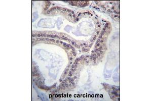 EIF1AY Antibody (N-term) (ABIN657081 and ABIN2846242) immunohistochemistry analysis in formalin fixed and paraffin embedded human prostate carcinoma followed by peroxidase conjugation of the secondary antibody and DAB staining.
