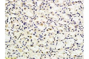 Formalin-fixed and paraffin embedded human gastric adenocarcinoma labeled with Anti-CD162 Polyclonal Antibody, Unconjugated (ABIN679298) followed by conjugation to the secondary antibody (SELPLG anticorps  (AA 251-350))