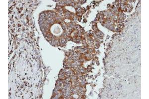 IHC-P Image Immunohistochemical analysis of paraffin-embedded human endo mitral ovarian cancer, using CTSS, antibody at 1:100 dilution. (Cathepsin S anticorps)