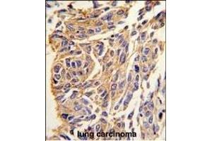 Formalin-fixed and paraffin-embedded human lung carcinoma tissue reacted with T1 antibody (C-term) (ABIN389117 and ABIN2839303) , which was peroxidase-conjugated to the secondary antibody, followed by DAB staining.