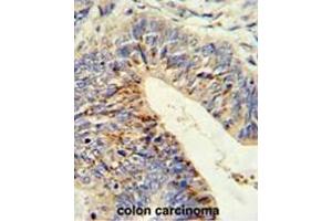 Formalin-fixed and paraffin-embedded human colon carcinoma reacted with ADAMDEC1 Antibody (N-term), which was peroxidase-conjugated to the secondary antibody, followed by DAB staining.