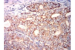 Immunohistochemical analysis of paraffin-embedded cervical cancer tissues using PLA2G7 mouse mAb with DAB staining.