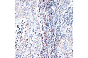 Immunohistochemistry of paraffin-embedded human esophageal cancer using DCP1A Rabbit mAb (ABIN7266678) at dilution of 1:100 (40x lens). (DCP1A anticorps)
